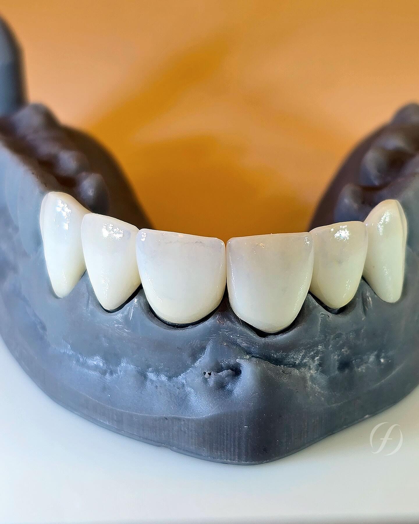 Modelo odontológico impresso em 3D com facetas estéticas de porcelana da clínica Ferdinand Odontologia, referência de dentista na Tijuca, Rio de Janeiro