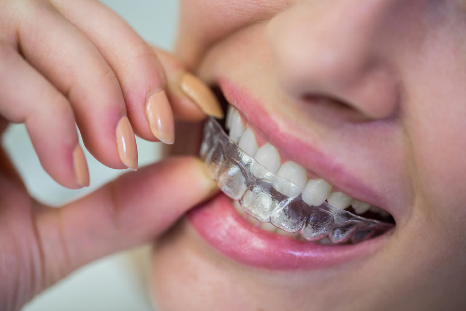 Paciente ajustando placa de alinhador transparente nos dentes superiores durante tratamento com alinhadores invisíveis na Tijuca.